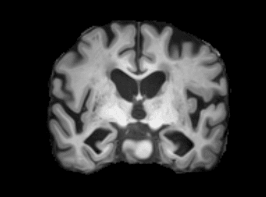 Structural brain MRI